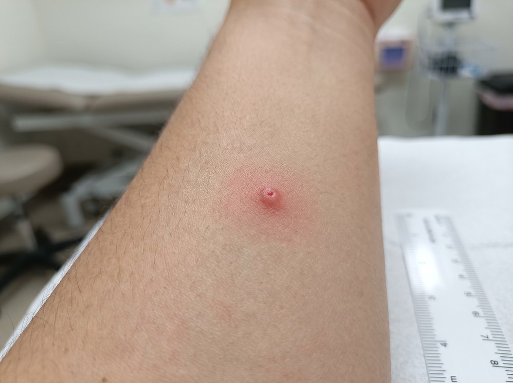 Close-up photo of a single small raised red welt on skin representing a fresh isolated cockroach bite mark