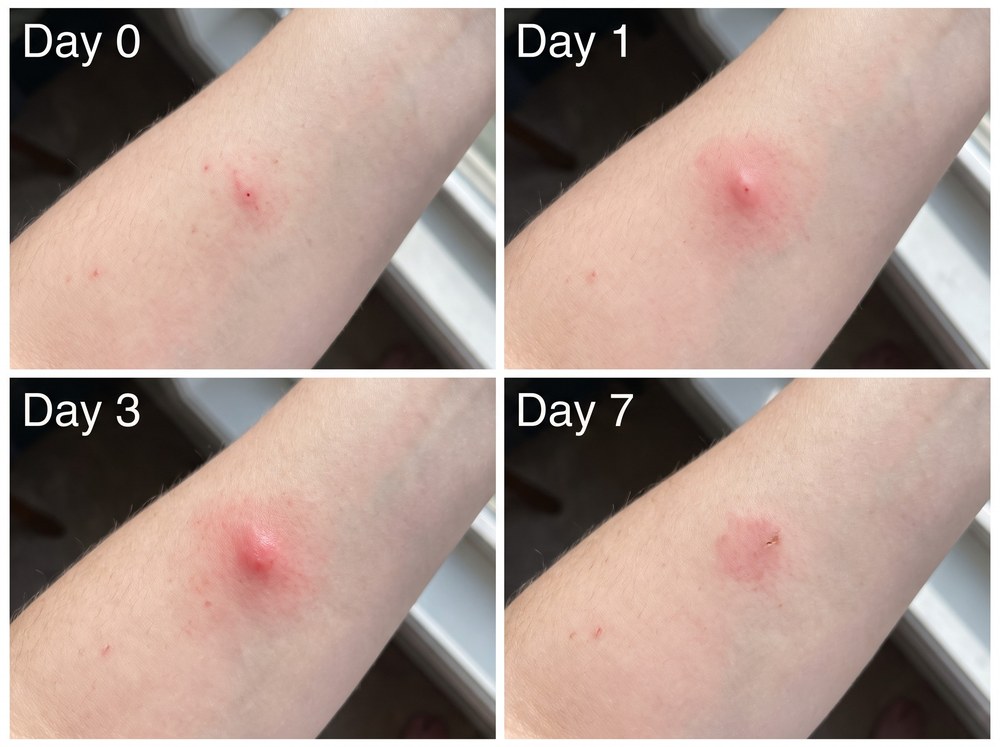 Side-by-side labeled comparison photo of a single German cockroach bite welt next to a clustered line of bed bug bites on skin